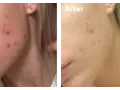 Före- och efterbilder visar en persons ansikte med akne. Efterbilden visar en klarare hy, troligen tack vare hormonell akne medicin.