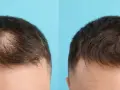 Före och efter bilder som visar resultat av microneedling hårbotten. Håret ser tätare ut efter behandlingen.