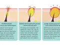 Illustrationer visar hur man får finnar: pormaskar, inflammatorisk akne och svår akne.