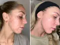 Före- och efterbilder visar en kvinnas hud med hormonspiral akne som förbättrats avsevärt.