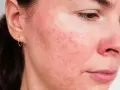 Närbild på en kvinnas ansikte med rodnad och flera inflammerade finnar, särskilt runt näsan och på kinden.