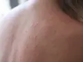 Hudutslag på ryggen, möjligtvis soleksem efter solarium.