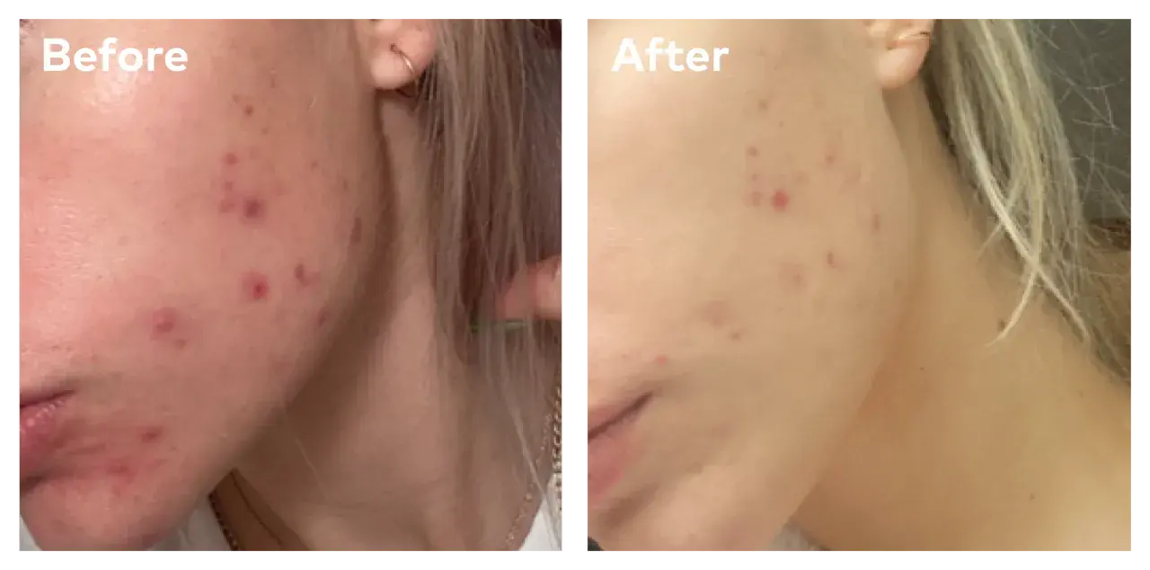 Före- och efterbilder visar en persons ansikte med akne. Efterbilden visar en klarare hy, troligen tack vare hormonell akne medicin.
