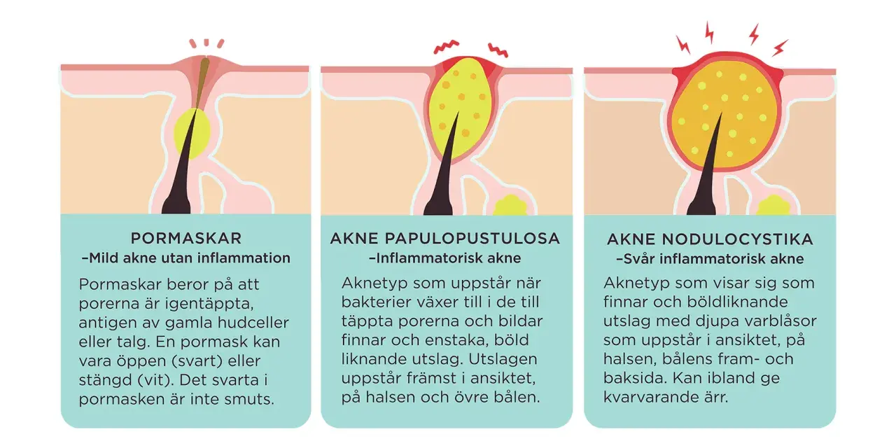 Illustrationer visar hur man får finnar: pormaskar, inflammatorisk akne och svår akne.