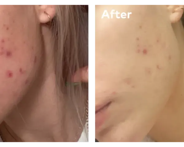 Före- och efterbilder visar en persons ansikte med akne. Efterbilden visar en klarare hy, troligen tack vare hormonell akne medicin.