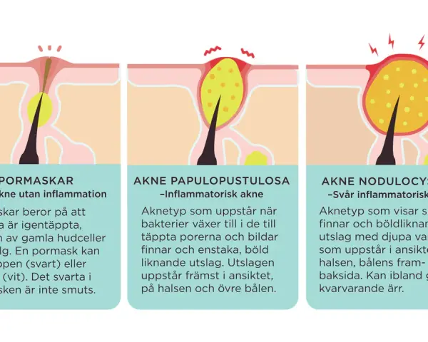 Illustrationer visar hur man får finnar: pormaskar, inflammatorisk akne och svår akne.