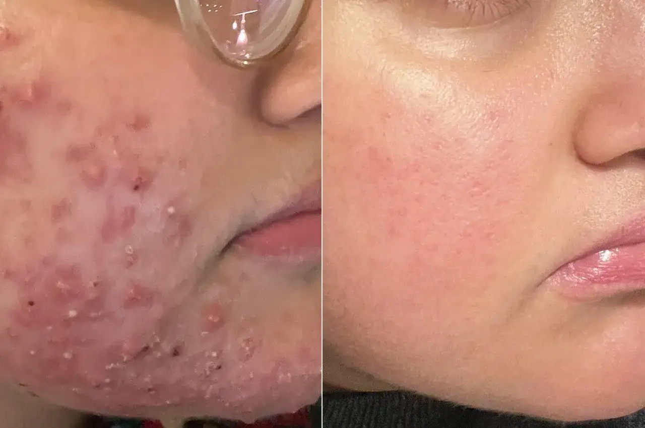 Före- och efterbilder visar en ansiktshalva med svår akne och atopisk hud, jämfört med en klar och slät hud efter behandling.
