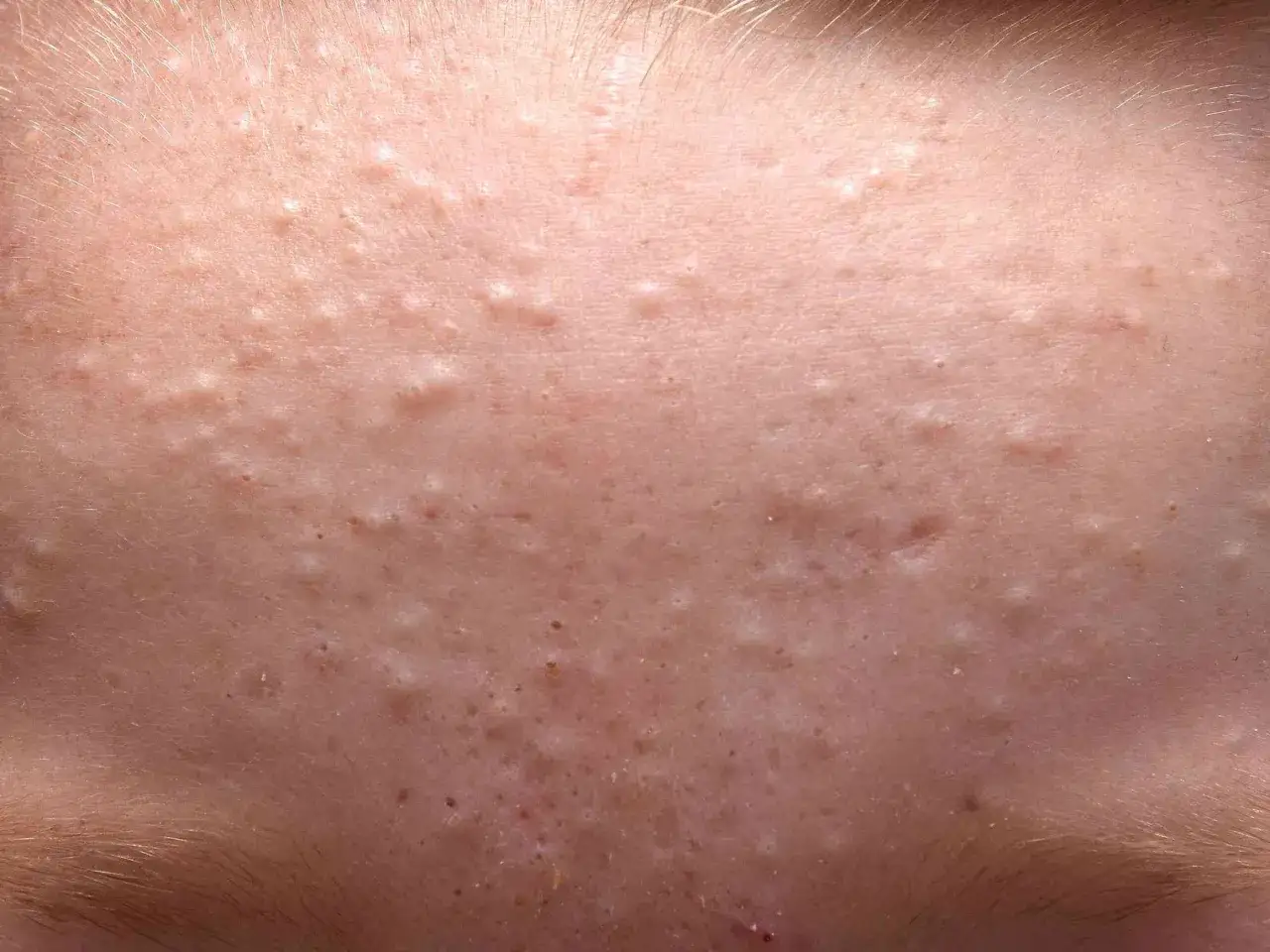 N&auml;rbild p&aring; hud med m&aring;nga sm&aring; vita prickar, som ser ut som vit pormask. Huden &auml;r ljus och har en del h&aring;rstr&aring;n.