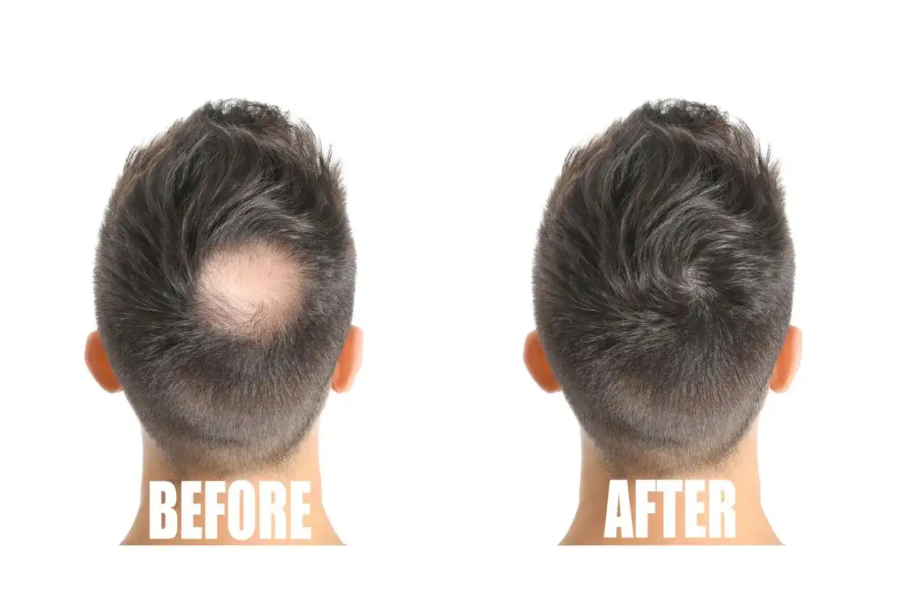 F&ouml;re och efter bilder som visar effekten av microneedling i h&aring;rbotten f&ouml;r att stimulera h&aring;rv&auml;xt.