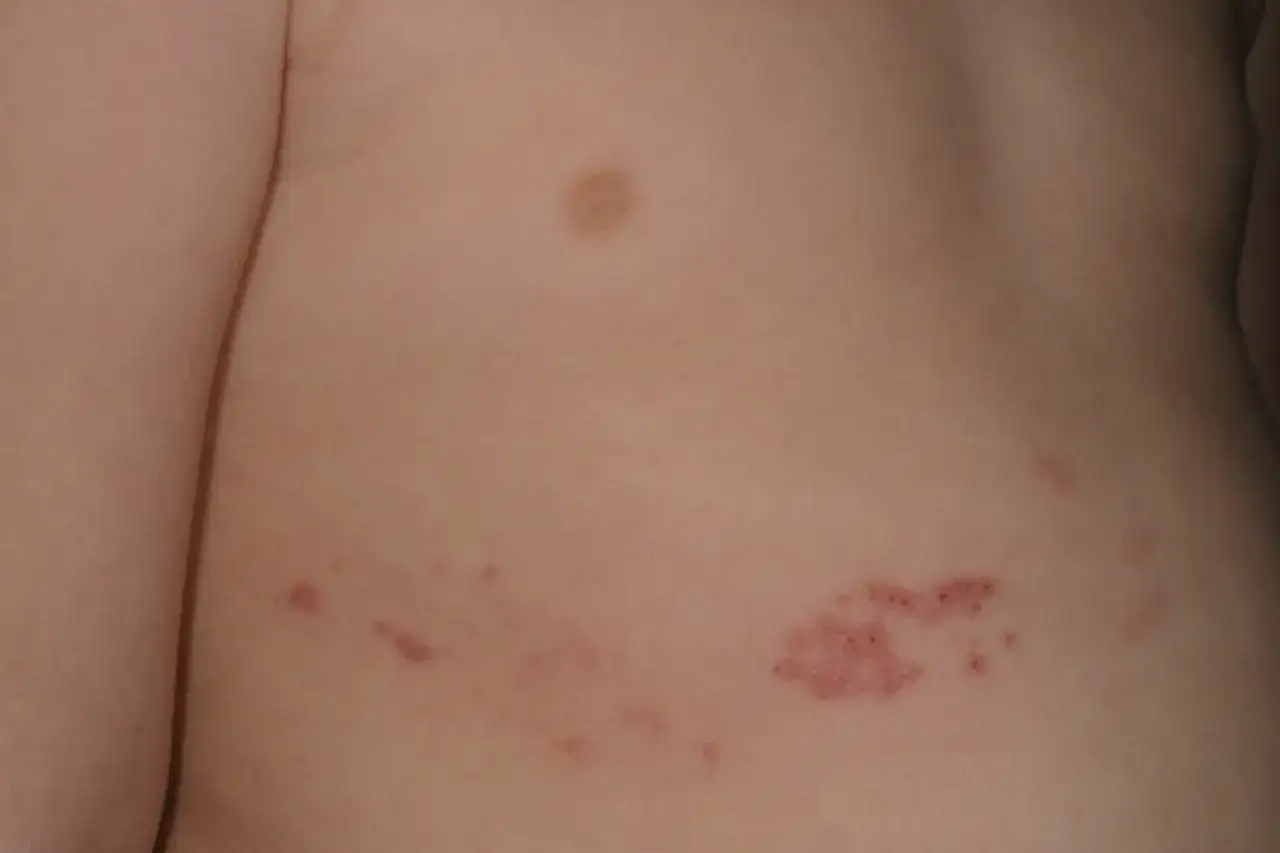 Barnets hud har utslag som kliar. Det syns sm&aring; r&ouml;da prickar och bl&aring;sor, en del samlade i grupper.